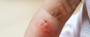 البعوض: لماذا يختارك أنت وكيف تتجنبه؟