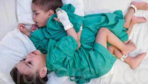 نجاح عملية فصل التوأم السيامي السوري “إحسان وبسام”.. استغرقت 9 ساعات