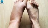 صحة القدمين من صحة الجسم ! أشياء تخبرك بها قدمك عن صحتك